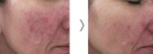 clearlift przed po 4