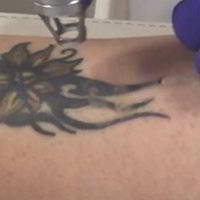 usuwanie tatuazy beautymedica