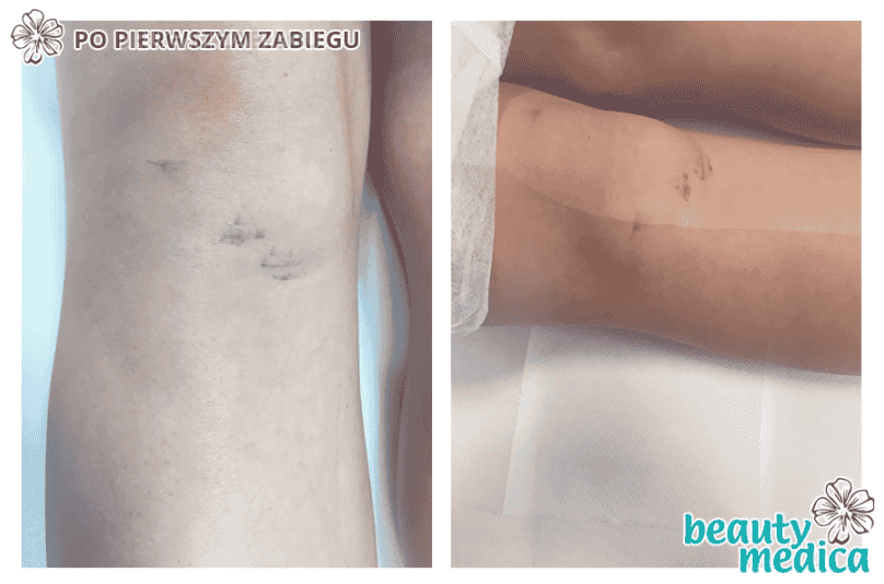 laserowe usuwanie tatuazu
