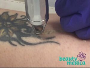 Laserowe usuwanie tatuaży.