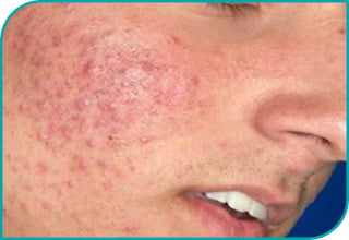 Laser Alma 420 nm ACNE - Przed