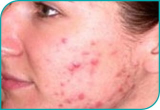 Laser Alma 420 nm ACNE - Przed