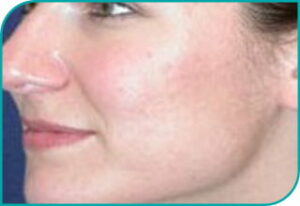 acne przed po 4