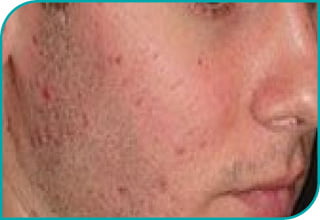 Laser Alma 420 nm ACNE - Przed