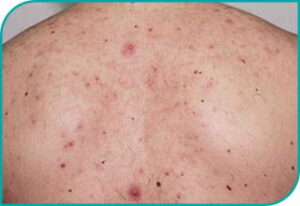 acne przed po 7