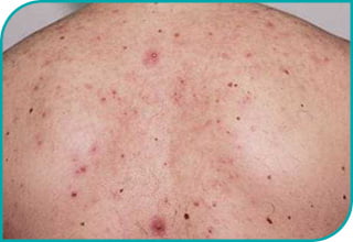 Laser Alma 420 nm ACNE - Przed