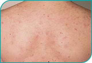 Laser Alma 420 nm ACNE - Po