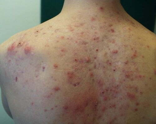 Laser Alma 420 nm ACNE