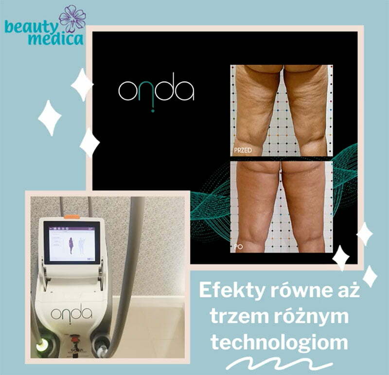 onda 3 zabiegi