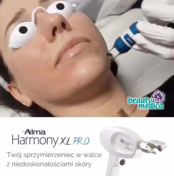 laser frakcyjny