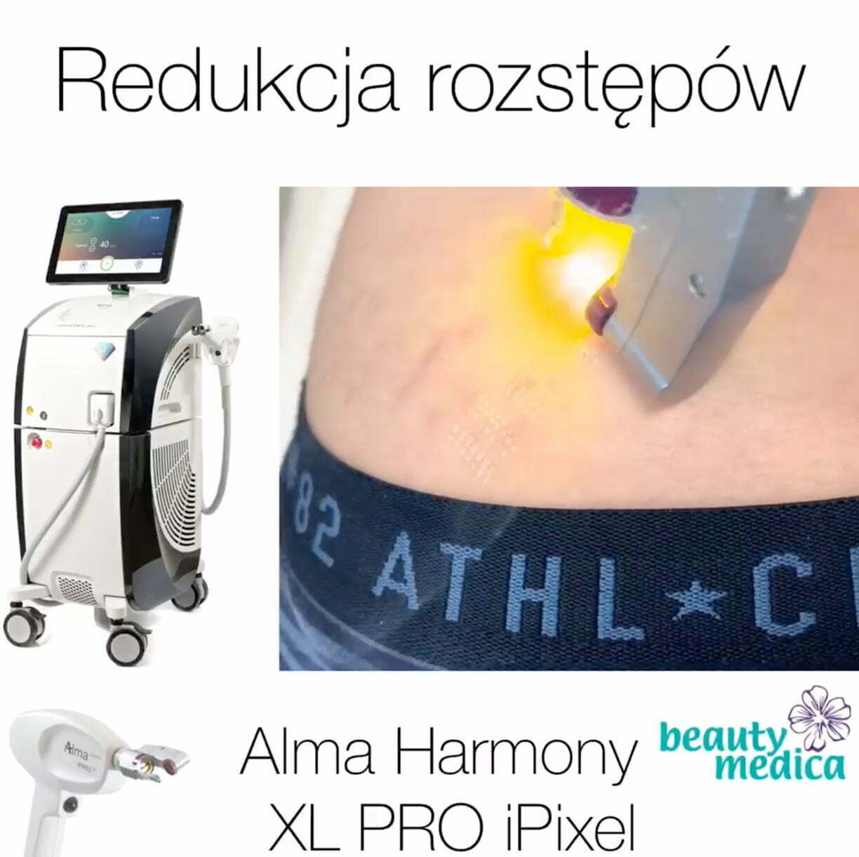 redukcja rozstępów