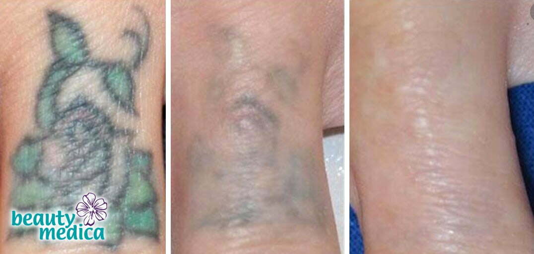 jak pozbyc sie tatuazu skutecznie