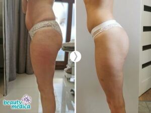 przed po beauty medica endermologia