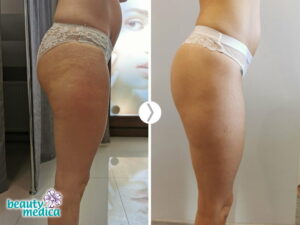 przed-po beauty medica endermologia 3