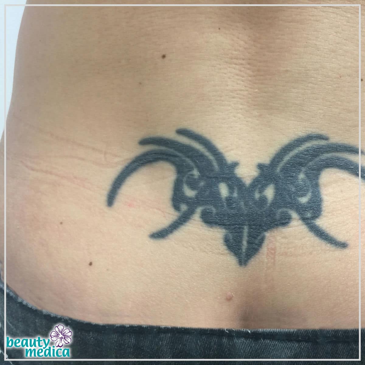 usuwanie tatuazu