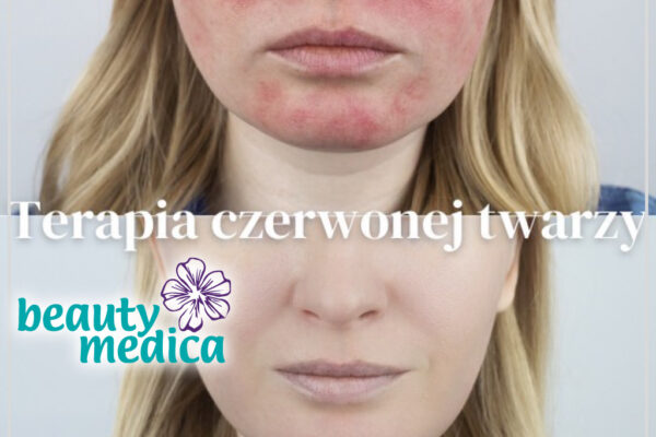 trądzik różowaty