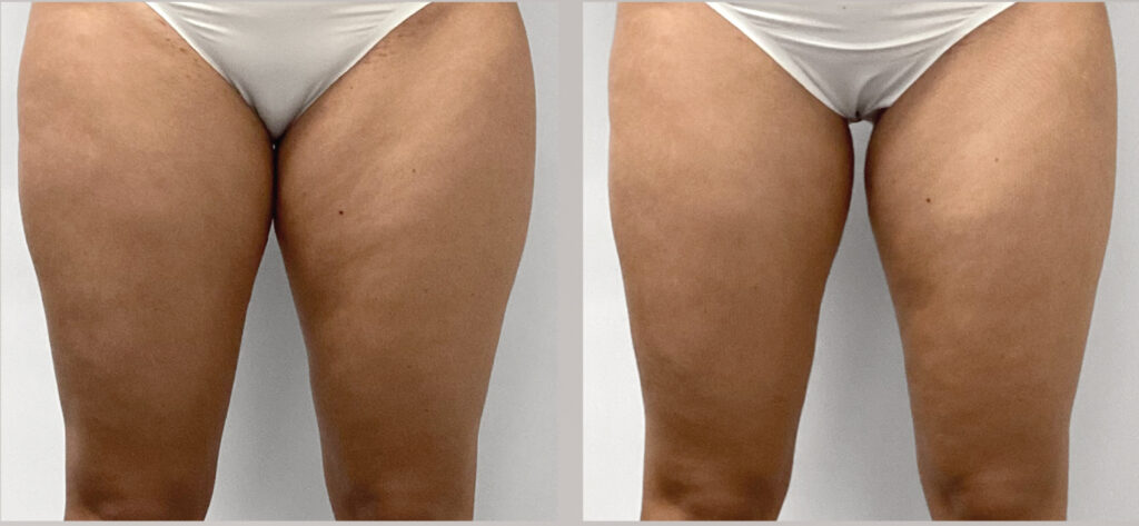 Endermologia LPG Infiniti - efekty