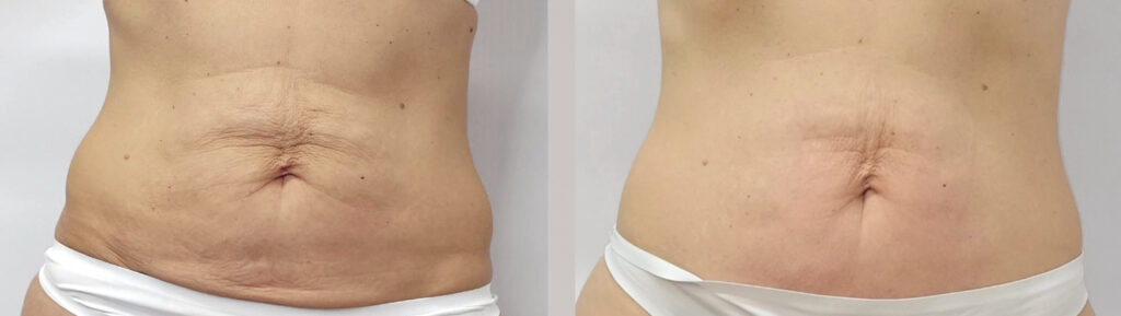 Endermologia LPG Infiniti - efekty