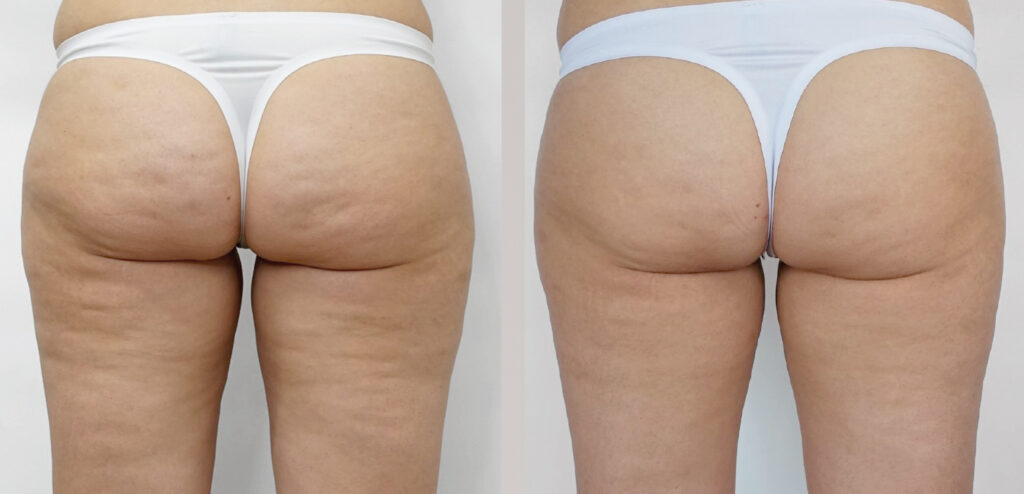 Endermologia LPG Infiniti - efekty