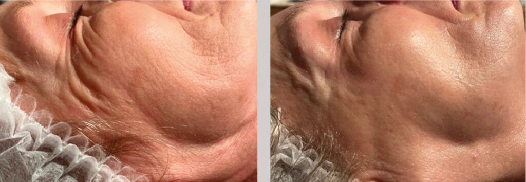 Endermologia LPG Infiniti - efekty