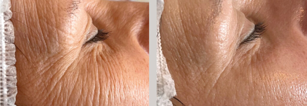 Endermologia LPG Infiniti - efekty